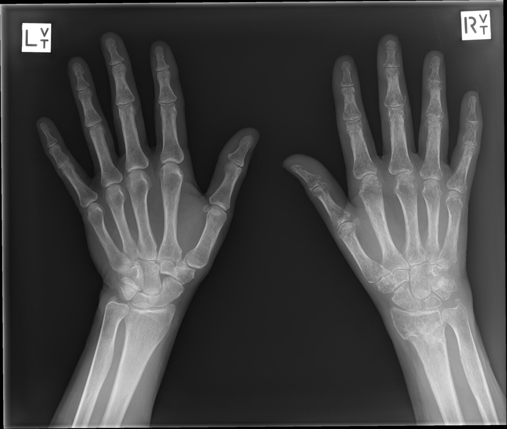 Синдром Зудека после перелома причины, симптомы, лечение и ЛФК
