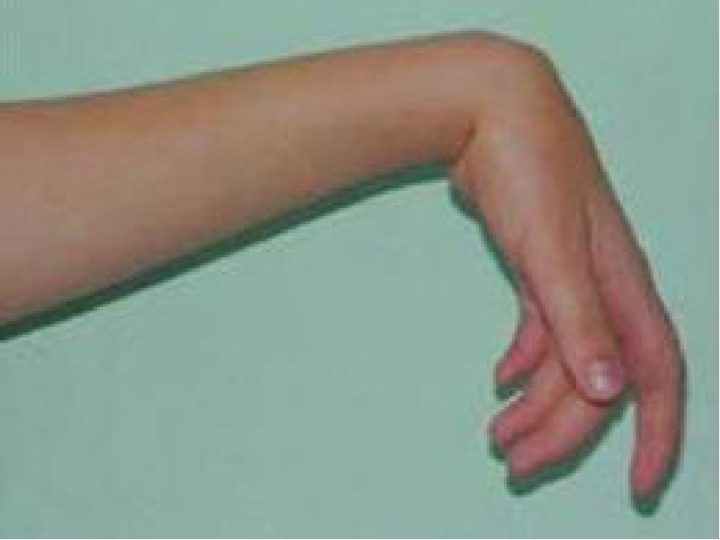 Травма лучевого нерва руки: восстановление и лечение травмы лучевого