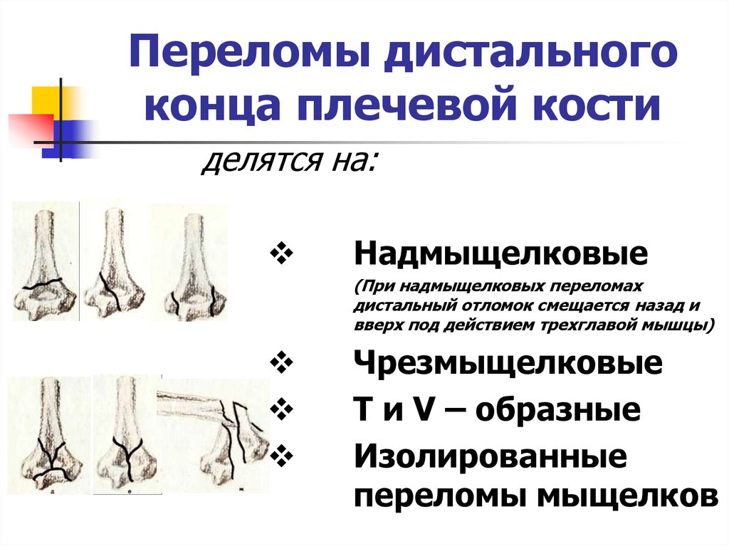 Переломы дистального отдела плечевой кости