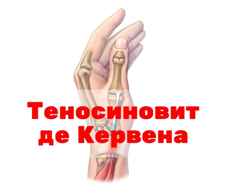 Теносиновит де Кервена: симптомы и лечение болезни де Кервена