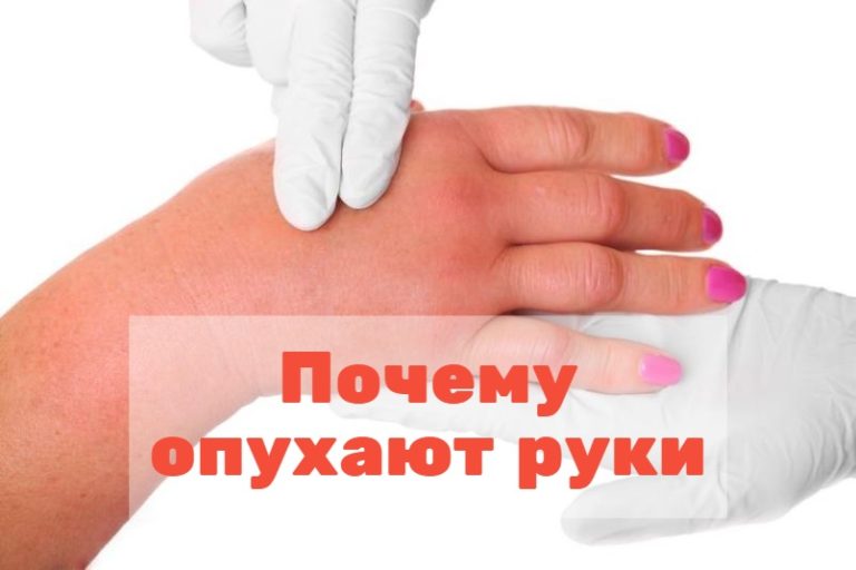 Опухают руки: причины, что делать, если опухли руки