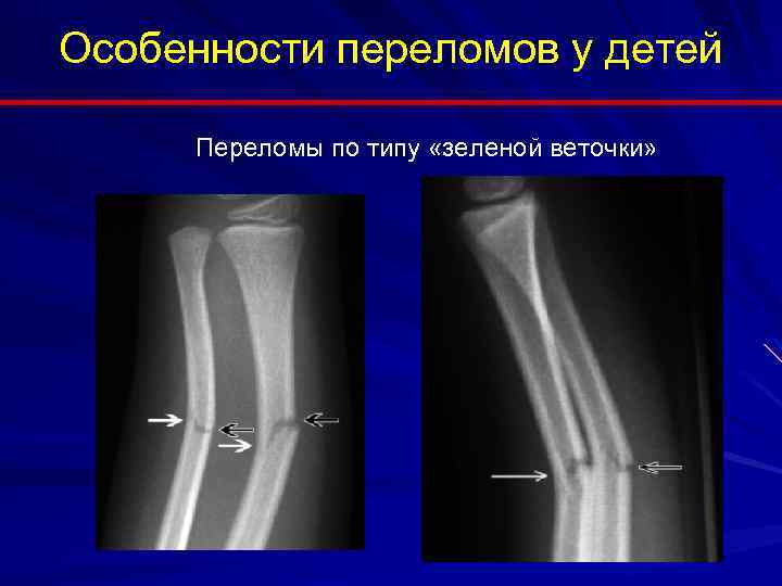 Перелом по типу зеленой ветки фото