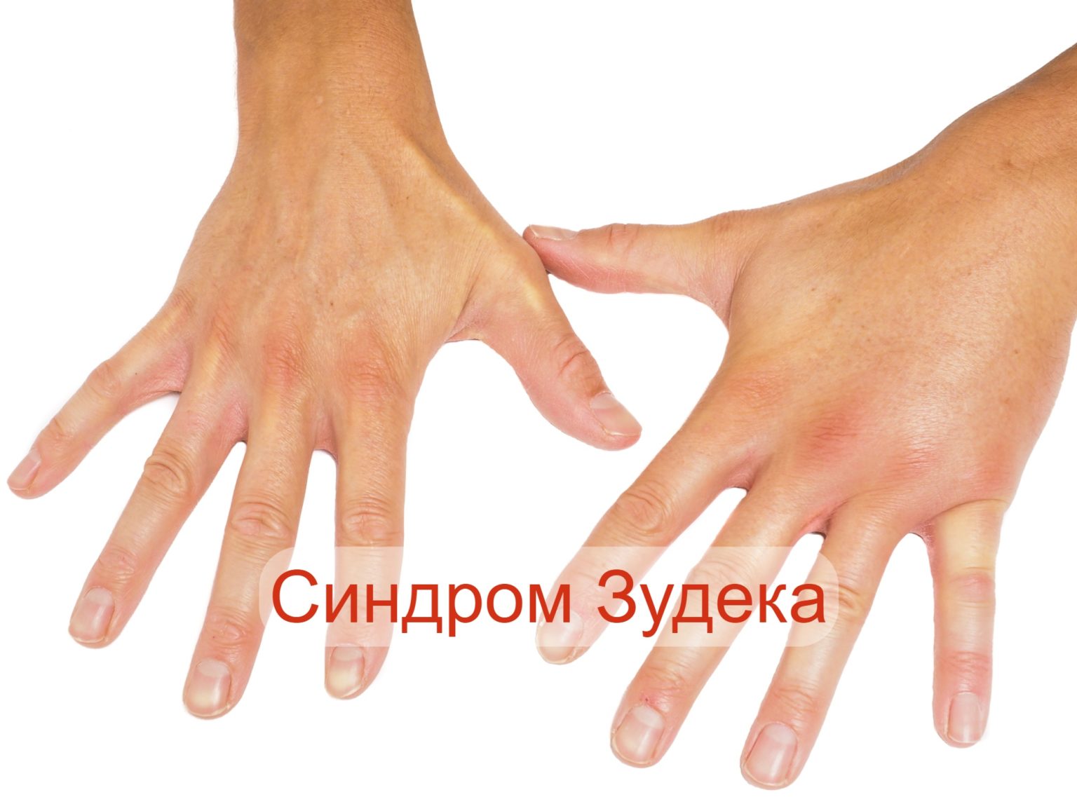 Синдром запястного канала симптомы, лечение, упражнения