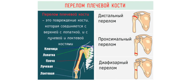 Перелом плечевой кости карта вызова